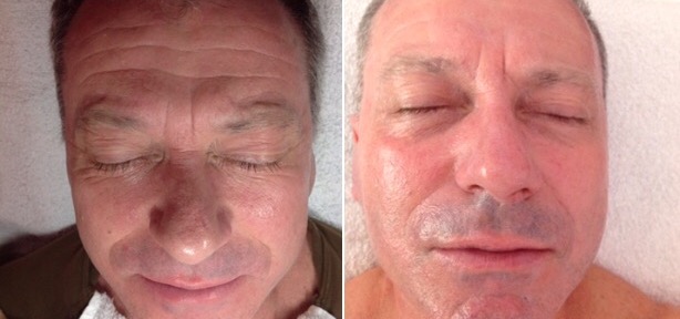 AF-Before-After