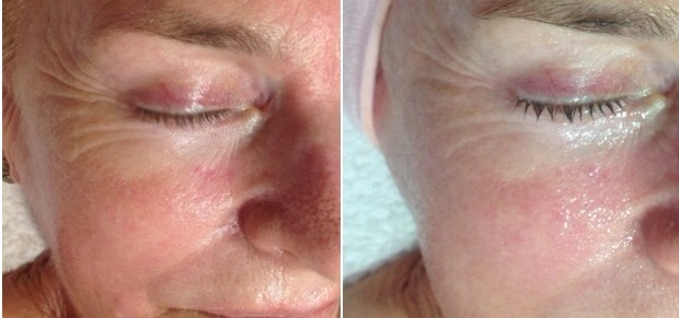 AF-Before-After2