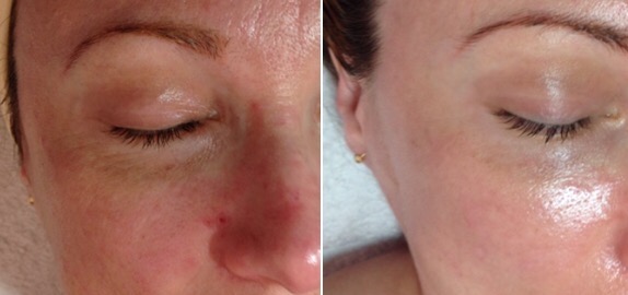 AF-Before-After3