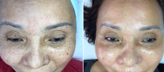 BeforeAndAfter_Facial