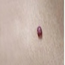 CherryAngiomas
