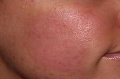 Scar3