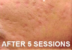SkinNeedling-1