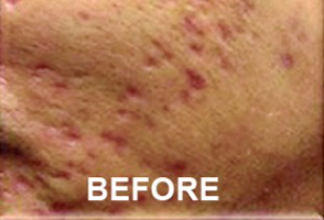 SkinNeedling-2