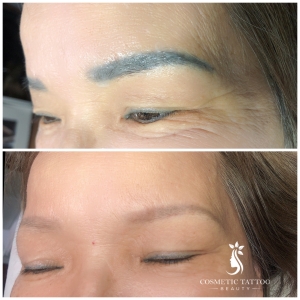 laser-tattoo-removal