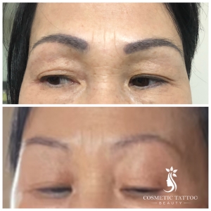 non-laser-removal