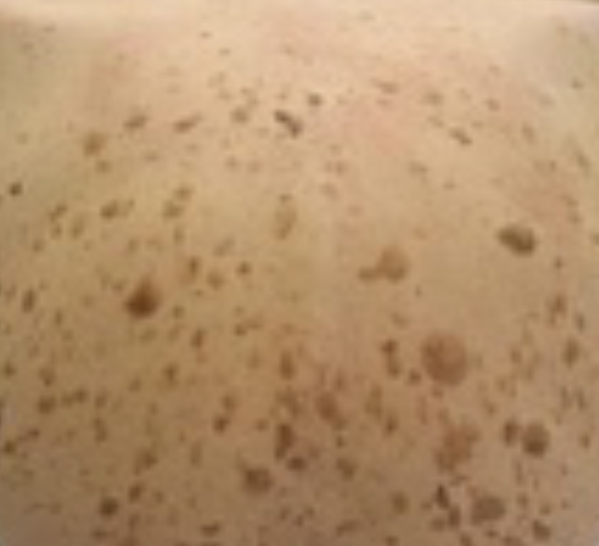 SeborrheicKeratosis