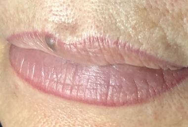 SebaciousHyperplasia