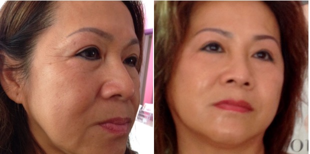 AF-Before-After