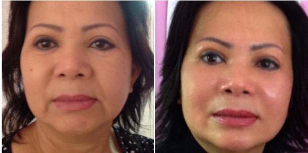 AF-Before-After