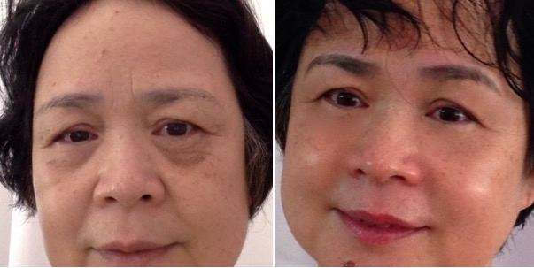 AF-Before-After