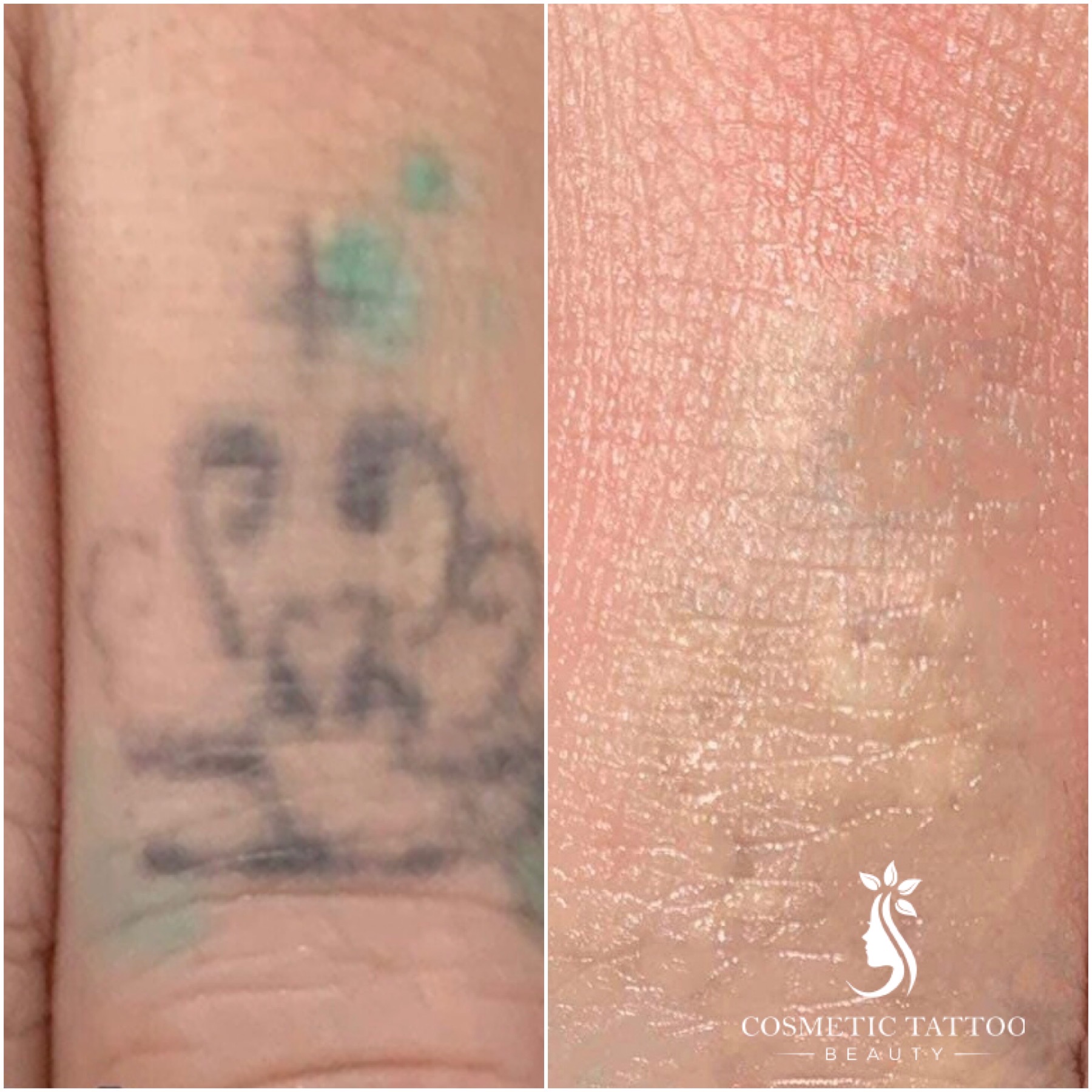 AF-Before-After